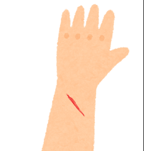 腕 傷.png